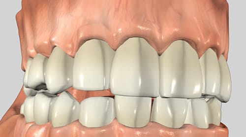 gum_lift